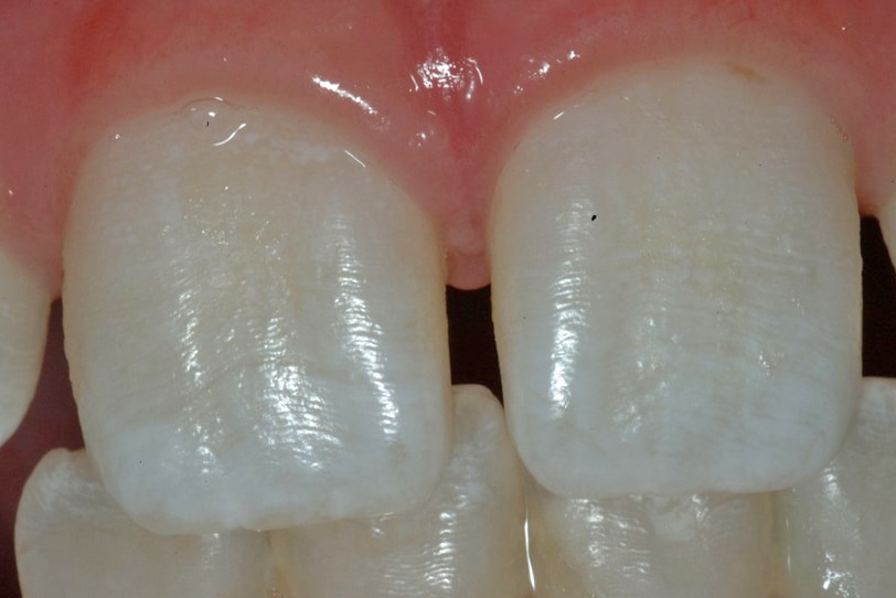 A mild example of fluorosis in teeth.