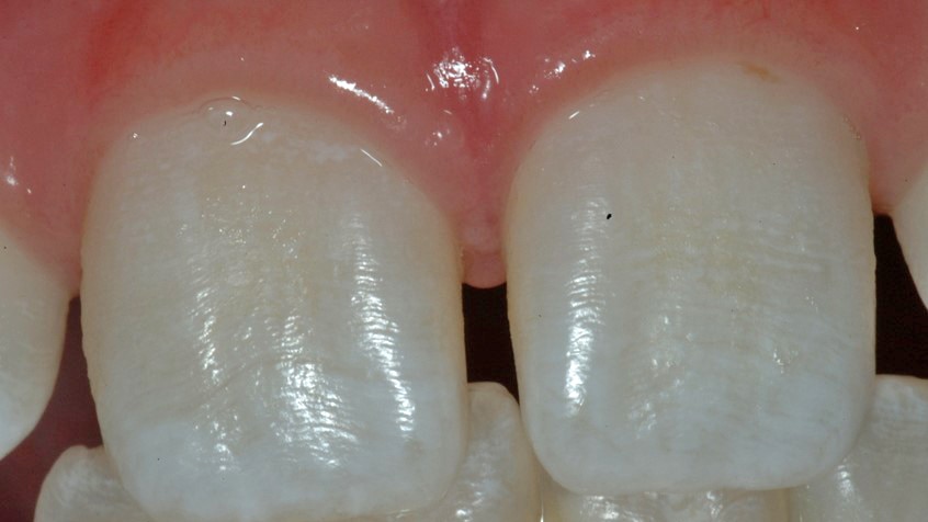 A mild example of fluorosis in teeth.