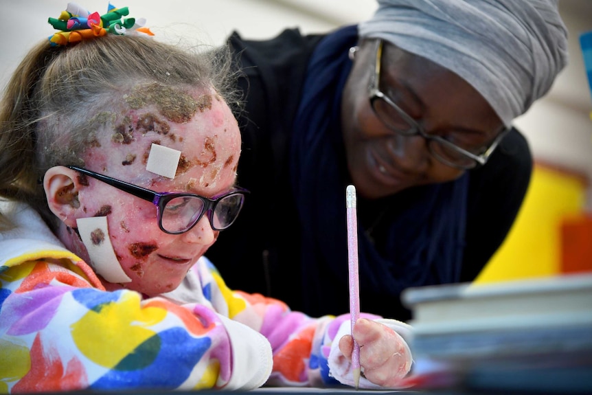 Nine-year-old girl with the genetic disorder epidermolysis bullosa.