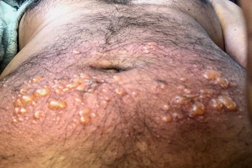 Yellowish blisters on a stomach around a man's hairy belly button, face obscured.