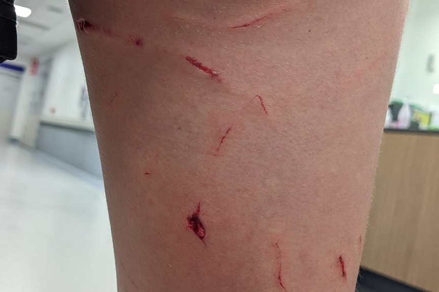  A young woman's leg showing cuts from a crocodile bite. 