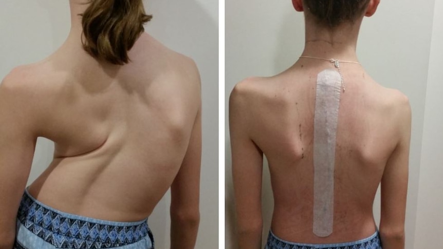 Opposing images of young netball Olivia's back before and after surgery to fix severe scoliosis.