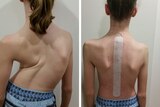 Opposing images of young netball Olivia's back before and after surgery to fix severe scoliosis.