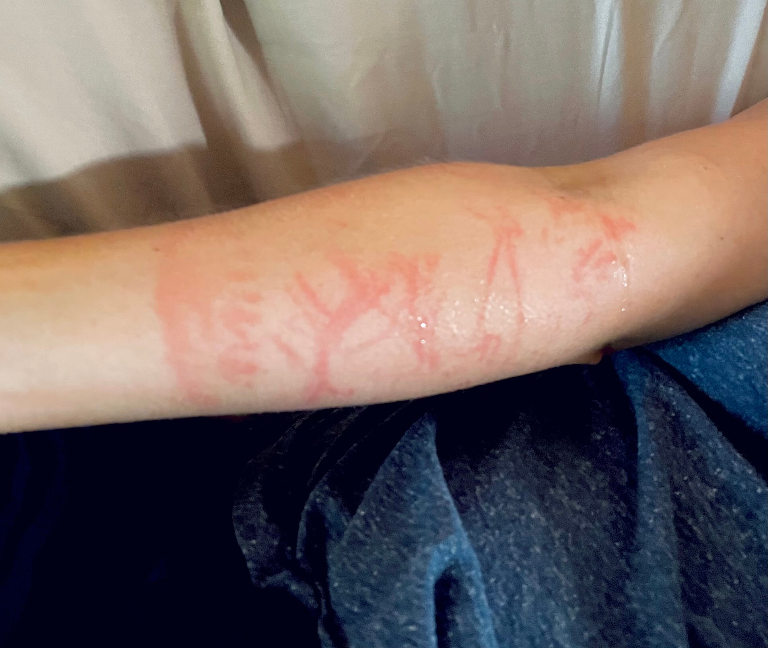 Call for research into jellyfish sting treatments, as experts admit