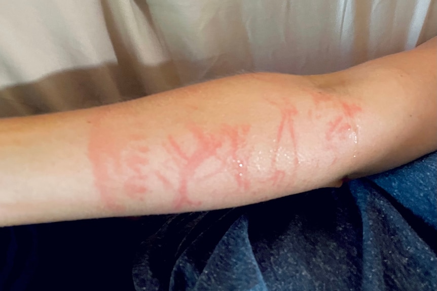 A fresh jellyfish sting on an arm