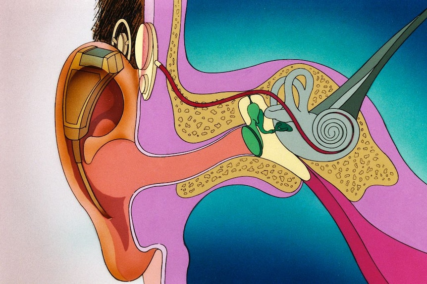 A diagram of a cochlear implant