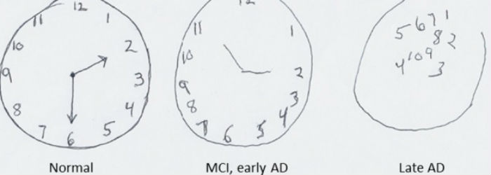 The clock-drawing task.