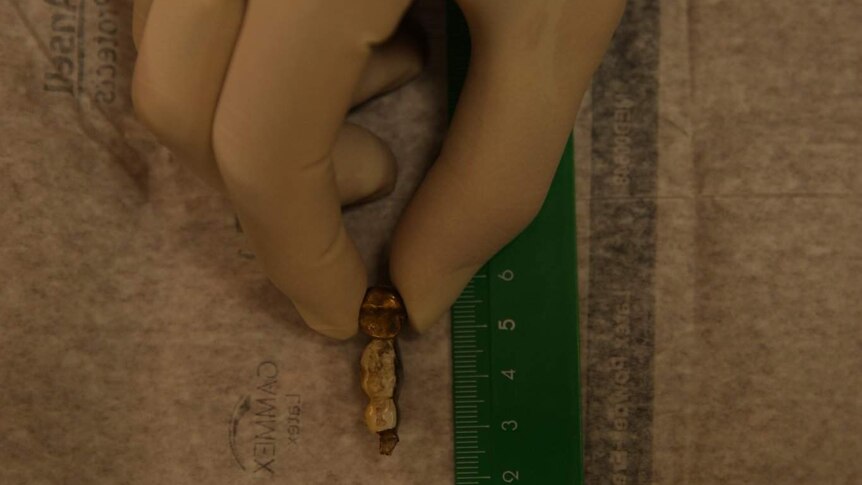 A gloved hand measuring some dentures.