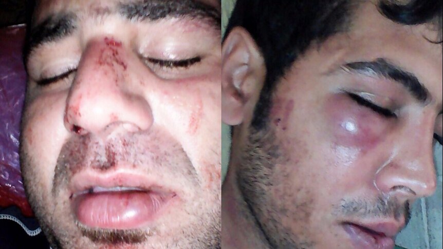 The injured faces of two Manus Island refugees. January 1, 2017