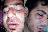 The injured faces of two Manus Island asylum seekers. January 1, 2017