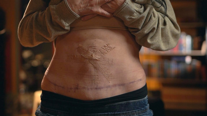 A woman's stomach, with a line of scarring across it. There is medical tape covering where her belly button would be.