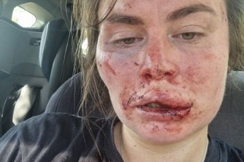 A woman with a bloodied and swollen face.