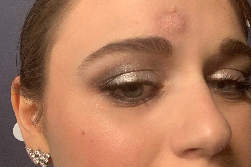 A round welt on the forehead of Joey King.