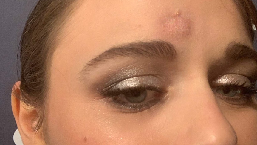 A round welt on the forehead of Joey King.