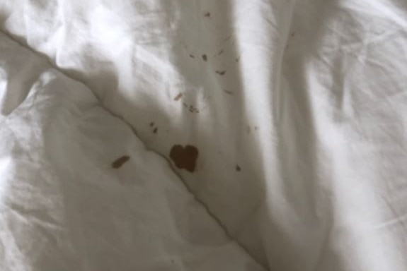 Spots of blood on a white doona.