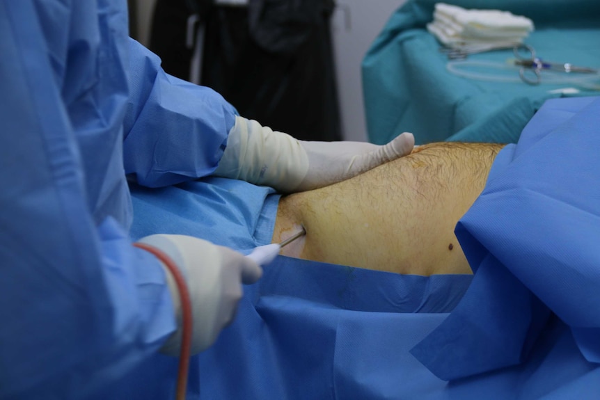 Liposuction is performed on a patient before a stem cell treatment.
