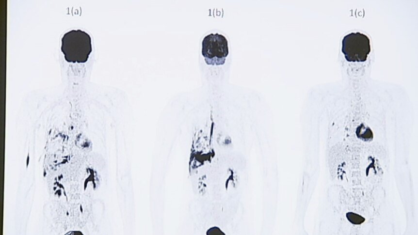PET scans of Bradley Selmon's lungs