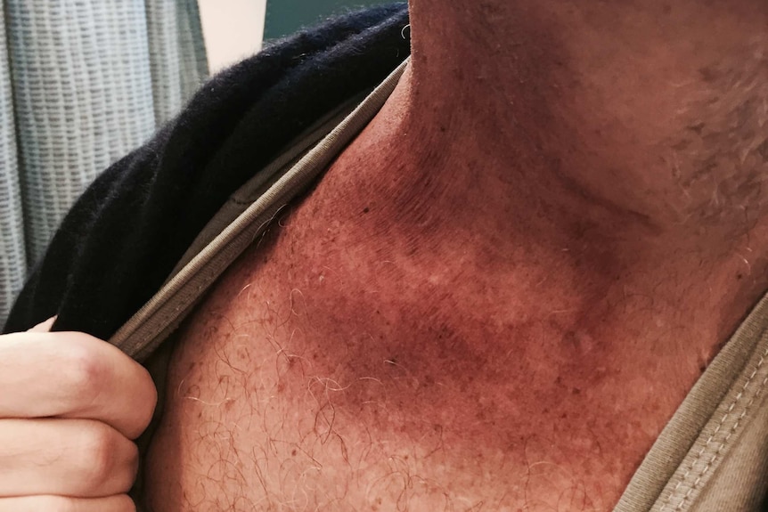 David Smiedt shows off a burn-like mark left by traditional radiation treatment
