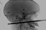 An X-ray shows the long, metal skewer sticking through Xavier's cheek under his eye and continuing to the back of his head.