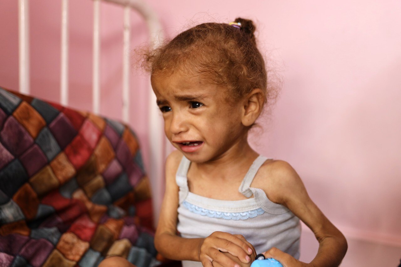 an emaciated child crying.