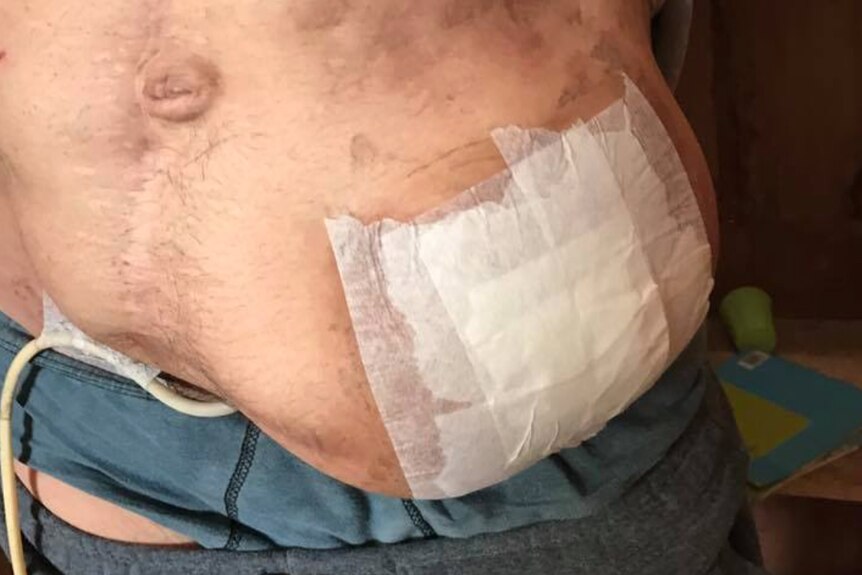 A wound on a man's abdomen is bandaged.