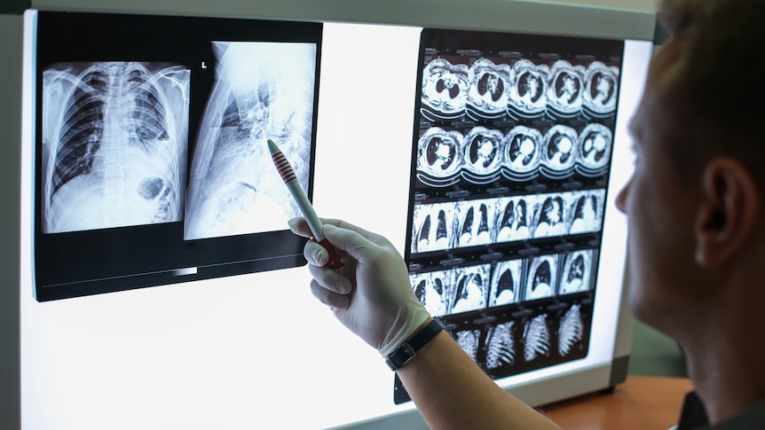 A health professional looking at lung scans from a patient with COPD, pointing a pen at one x-ray.