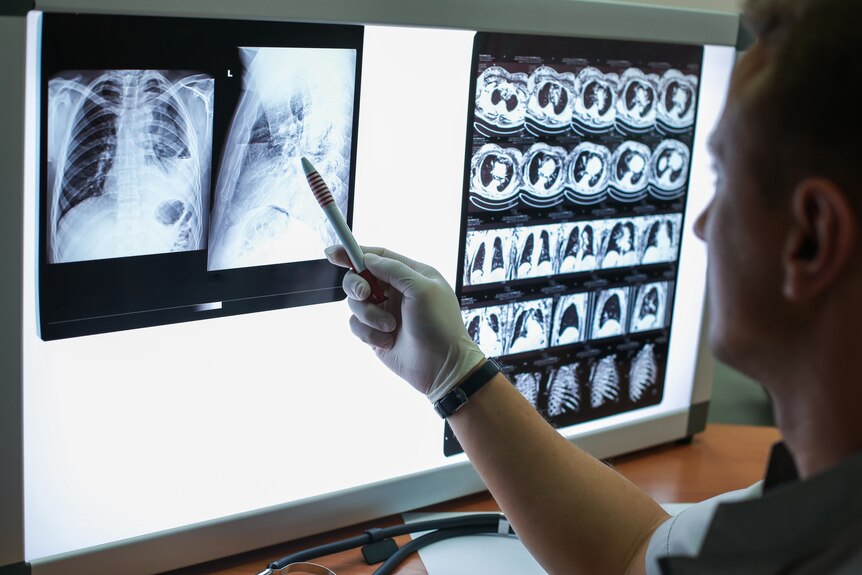 A health professional looking at lung scans from a patient with COPD, pointing a pen at one x-ray.