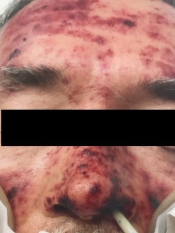A man's face is has red and purple patches from blood spots, he also has a hospital cord in his nose