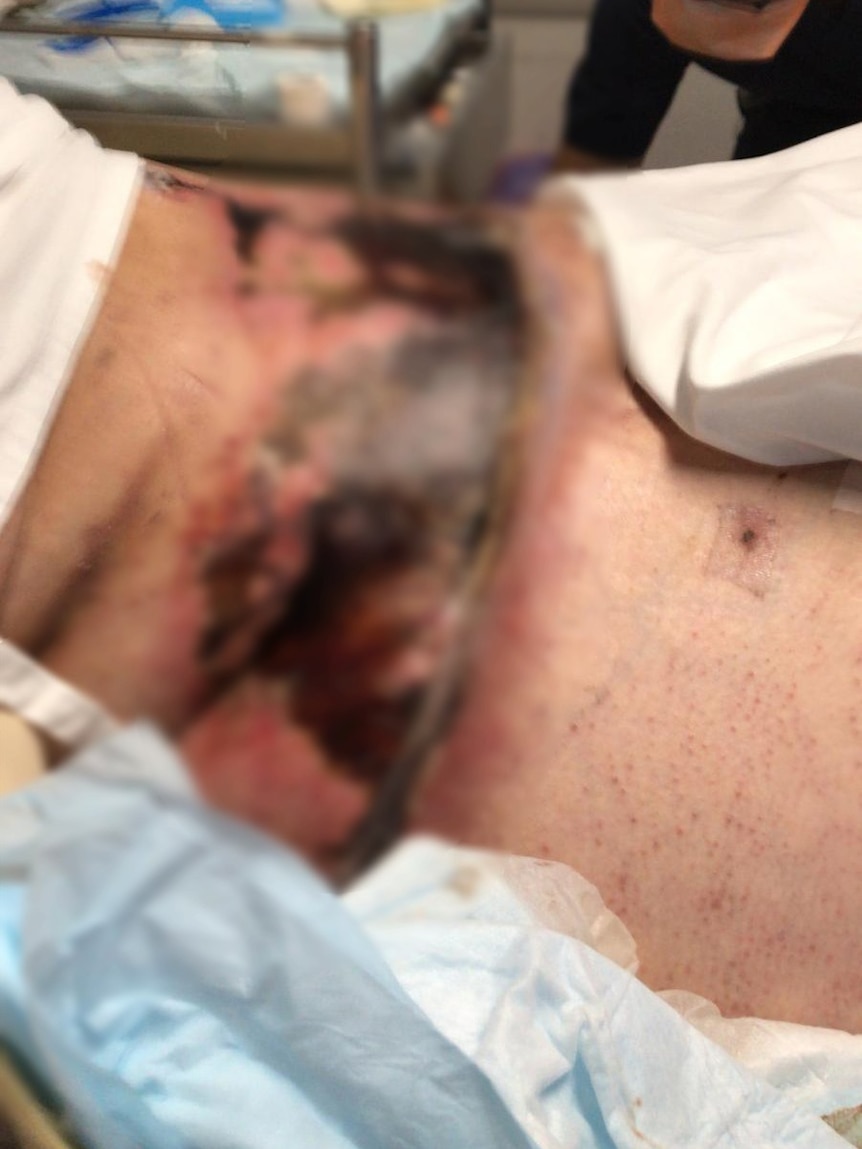 A close up but blurred photo of a woman's post surgical abdomen with dark bruising and inflammation