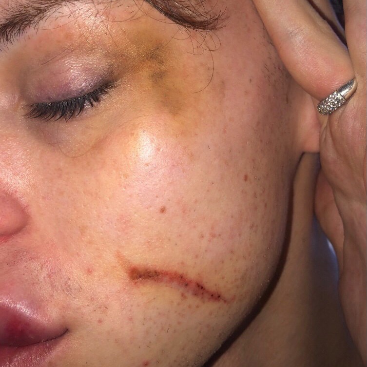 A woman shows her scratched and bruised face