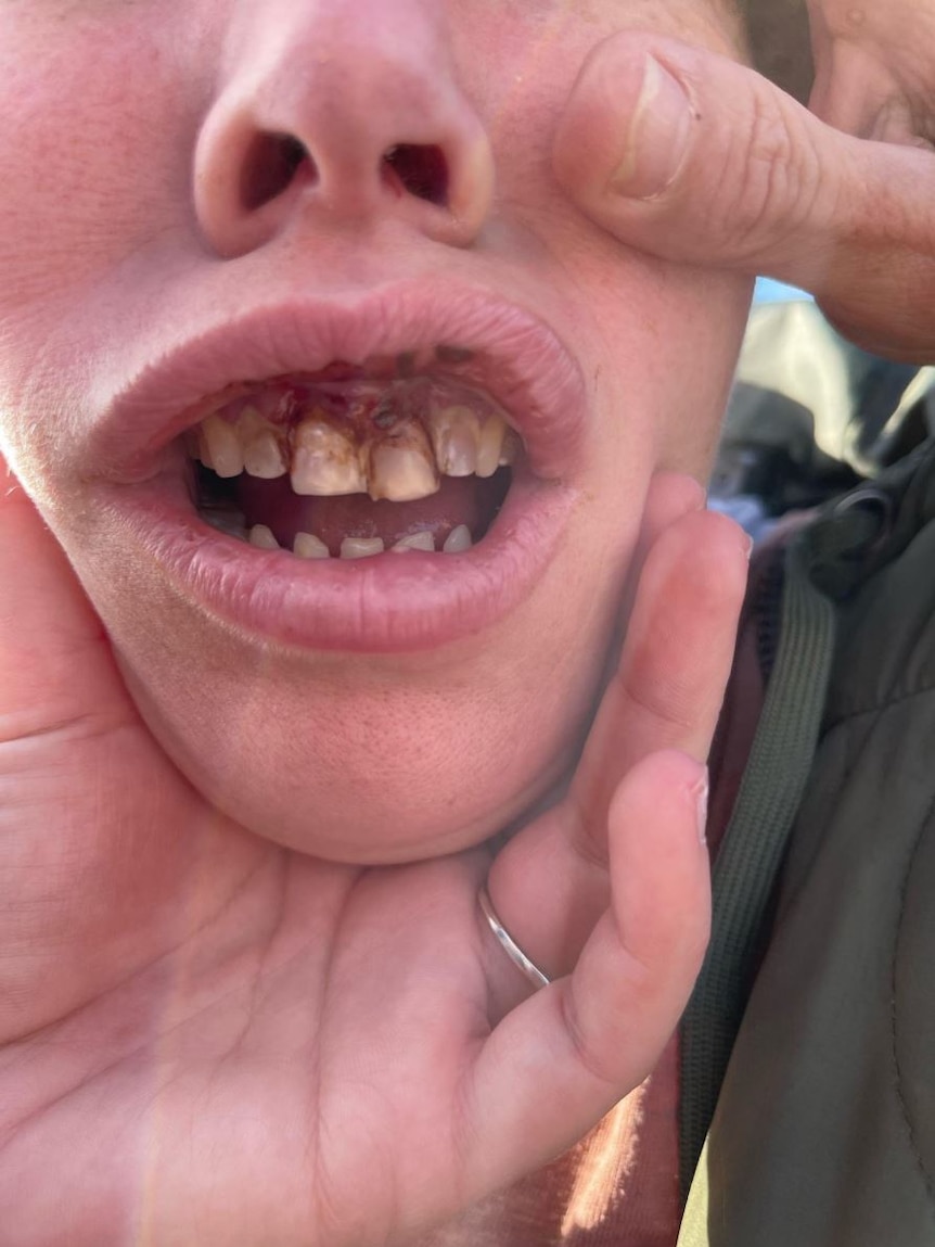 A close up of a young woman's mouth. Some of her front teeth appear to sit loosely in her bloodied gums.