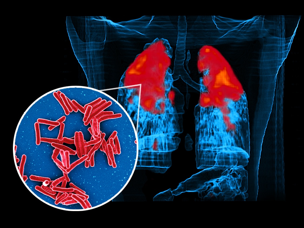 A graphic showing the bacterium Mycobacterium tuberculosis in the lungs