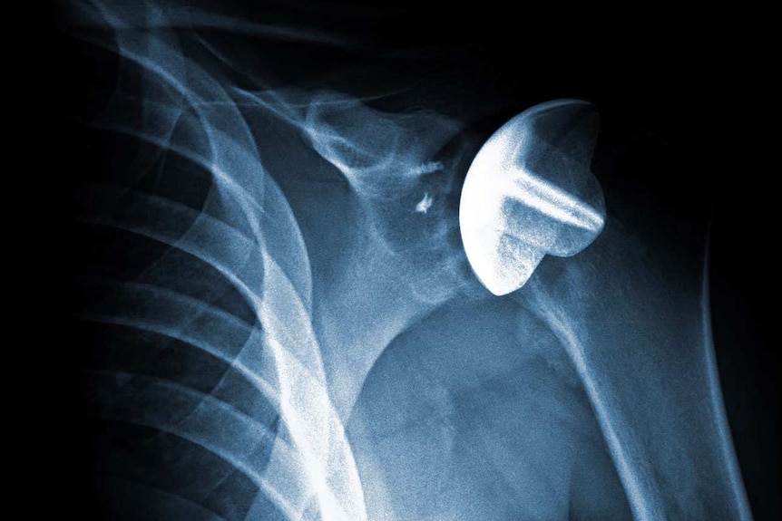 An X-ray showing Wolfgang Neszpor's shoulder implant.