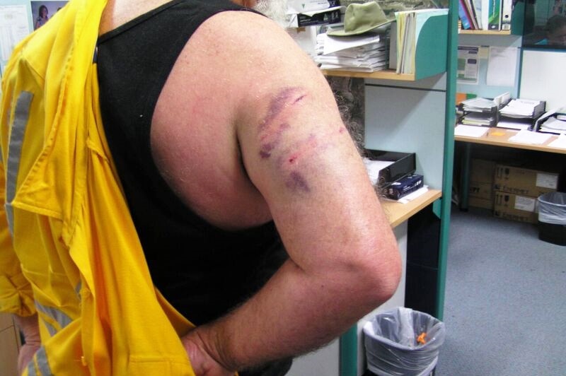 A Queensland energy meter reader staff member with a dog bite injury on right arm.