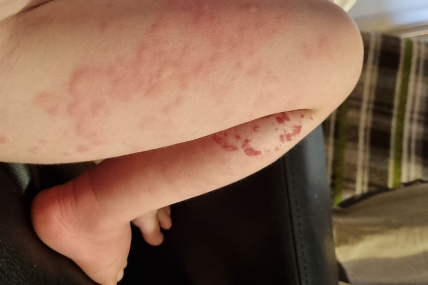 A rash on a child's leg.