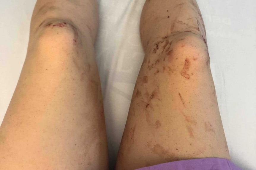 Ms Rich shares a photo of her bloodied legs in a sunshine coast hospital.