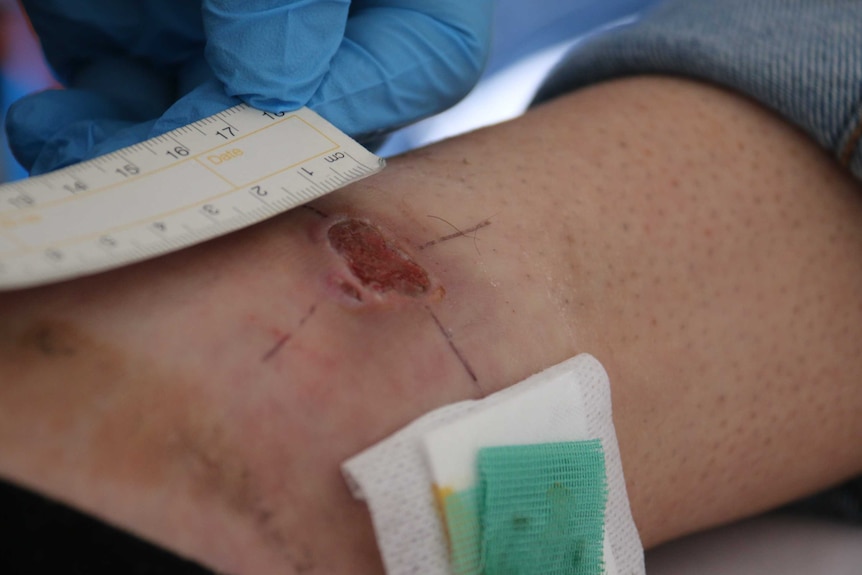 A tape measure next to a Buruli ulcer on a woman's ankle.