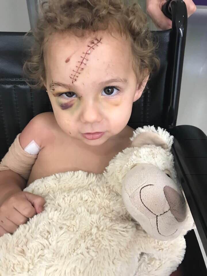 Toddler bitten on the face by family dog returns home after a week in