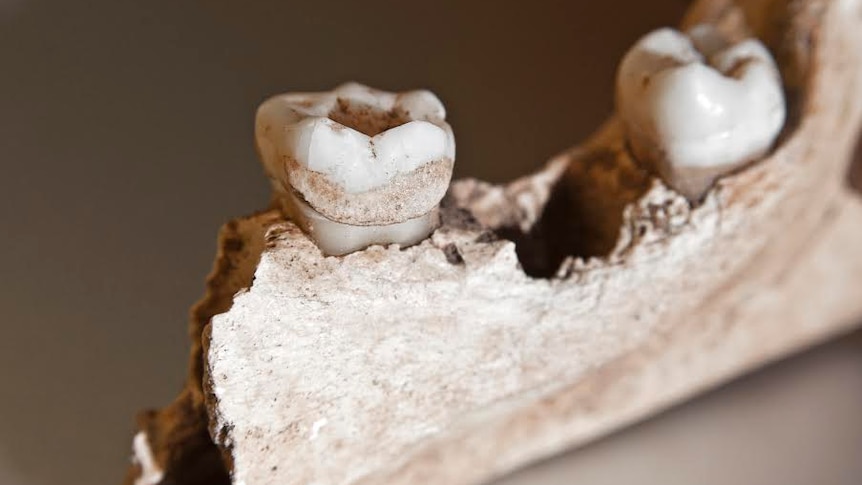 Tooth plaque from ancient skeletal remains