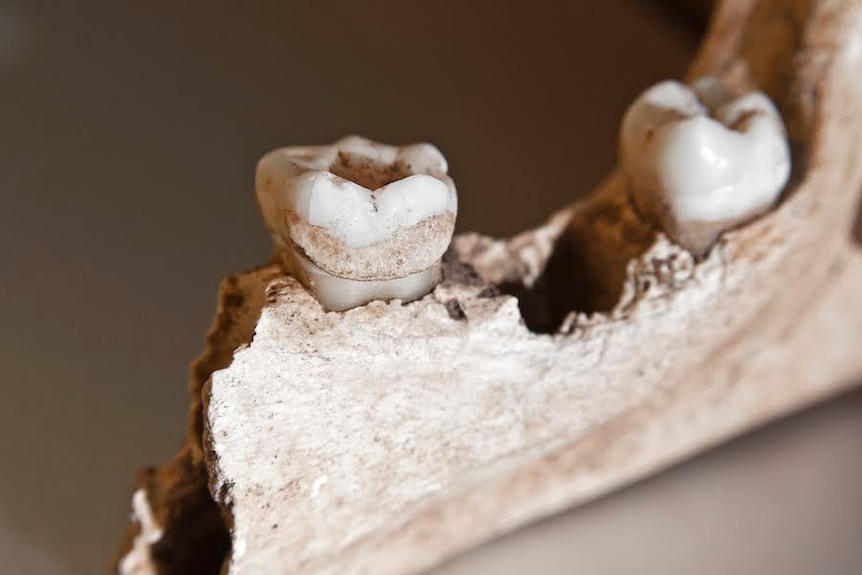 Tooth plaque from ancient skeletal remains