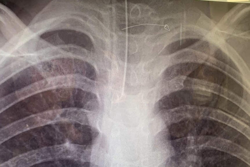 A computer screen displays an X-ray of a ribcage.