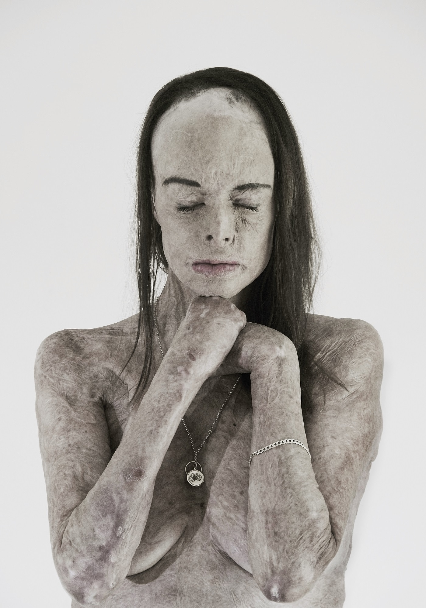 A woman with scarred skin poses nude with her eyes closed.