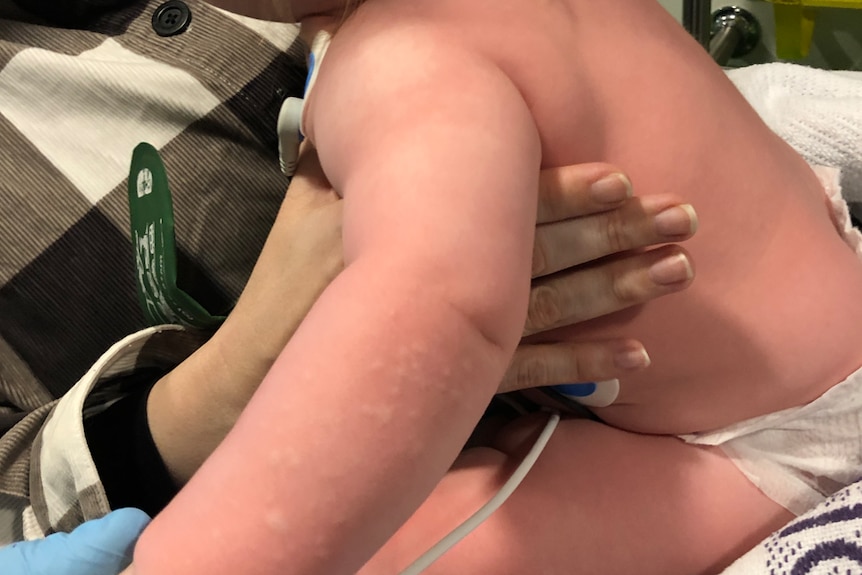 Baby with an allergic reaction along her arm, being held in an ambulance.