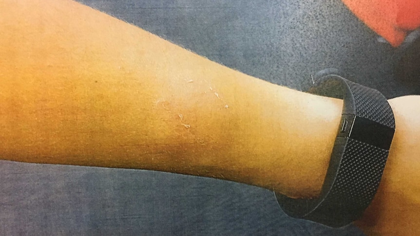 A close-up image of a woman's forearm showing a bite mark.