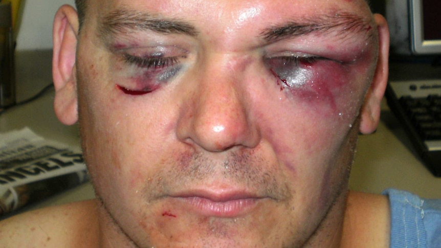 Victim of Matthew John Horner who took offence at criticism over his chicken parmigiana and broke his eye sockets in Bunbury Regional Prison