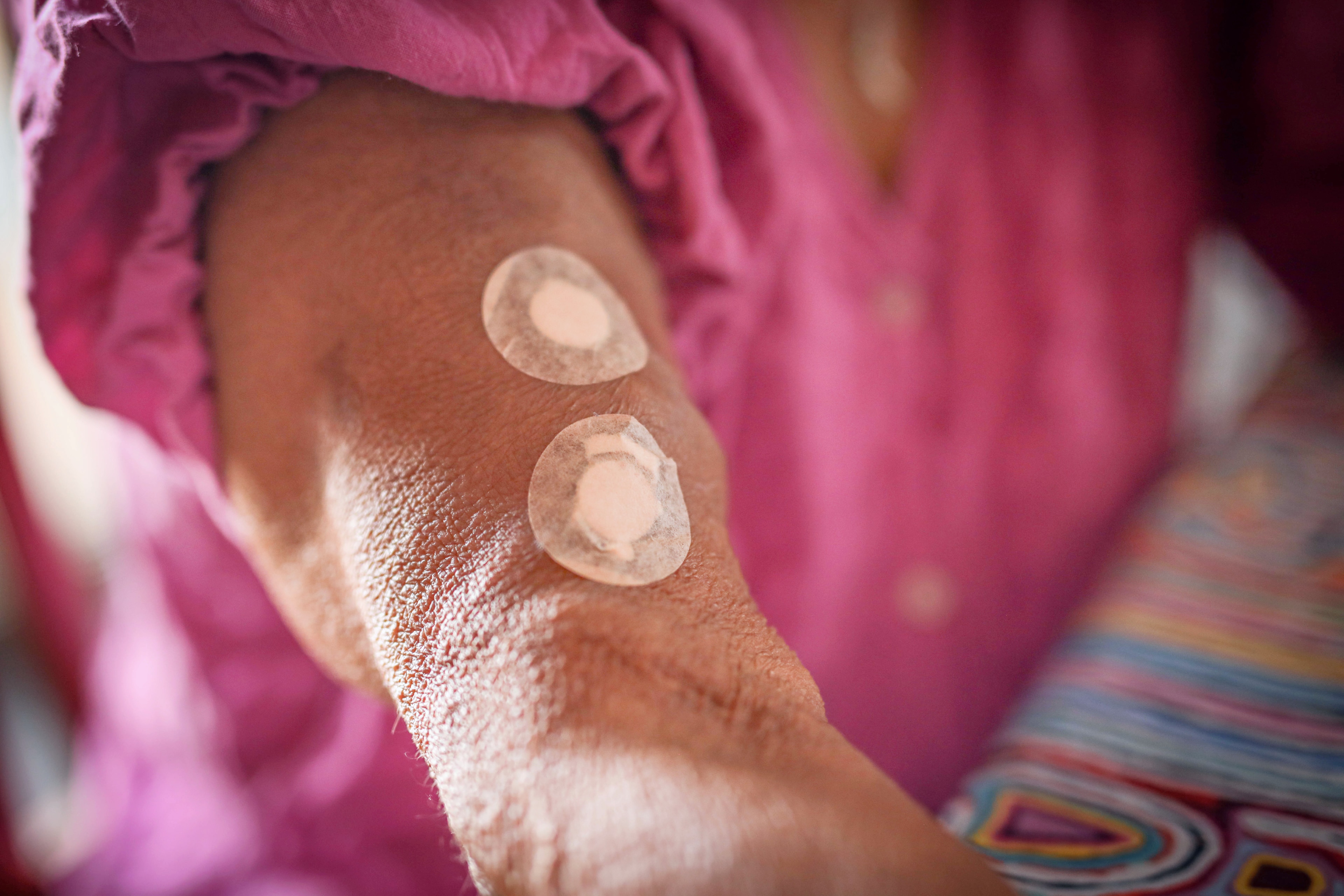 Close up of arm with bandaids