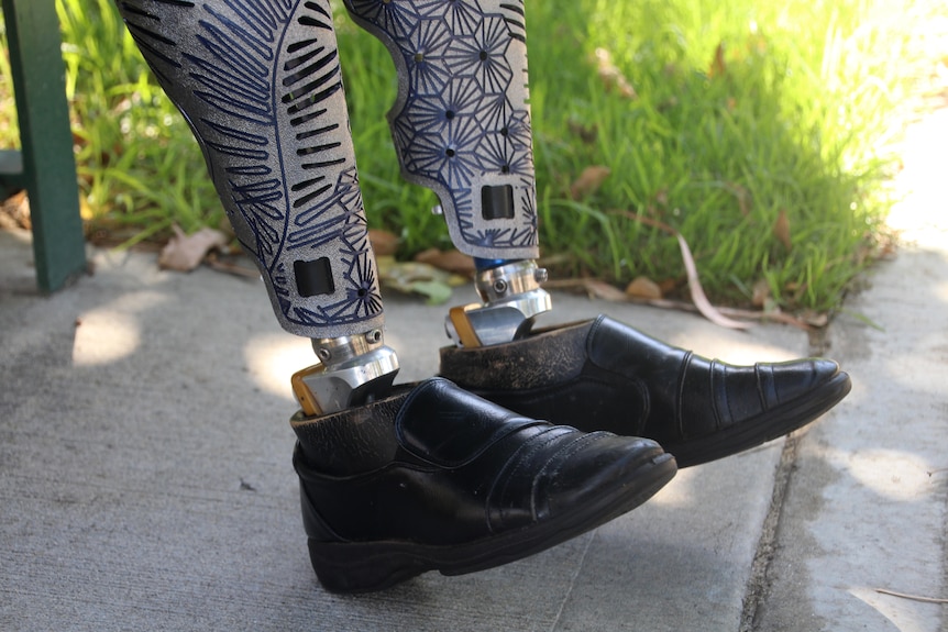 A tight shot of Lisa Burnette's prosthetic legs.