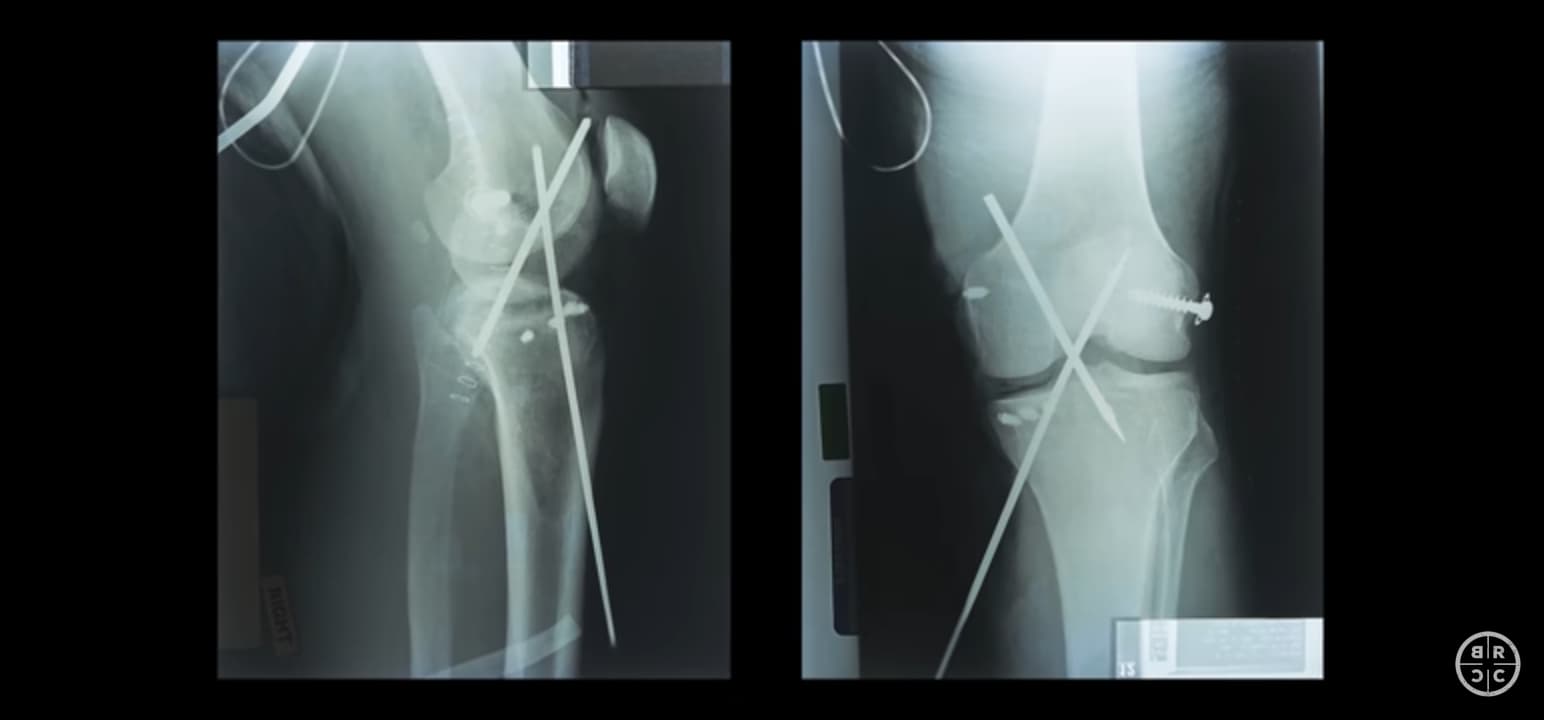X-ray of broken legs with pins holding bones together.