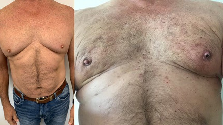 A composite image of a man's chest before and after surgery. The after photo his chest and nipples appear uneven.