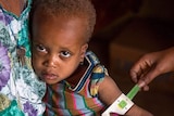A boy receiving medical treatment for malnutrition in Ethiopia